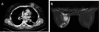 Breast metastasis of cervical cancer: A case report and systematic literature review